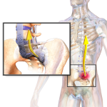 Ankylosing Spondylitis in West Hills, CA