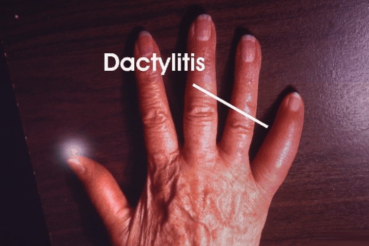 Psoriatic Arthritis | West Hills, CA | Dr. Nazanin Firooz