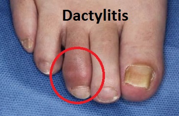 Signs and Symptoms of Ankylosing Spondylitis in West Hills, CA