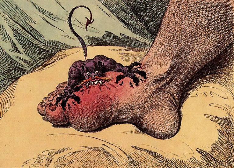 Gout in West Hills, CA