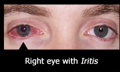 Psoriatic Arthritis | West Hills, CA | Dr. Nazanin Firooz