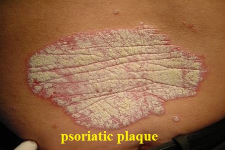Psoriatic Arthritis | West Hills, CA | Dr. Nazanin Firooz