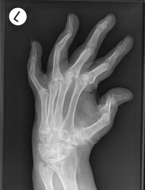 Psoriatic Arthritis | West Hills, CA | Dr. Nazanin Firooz