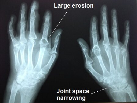 Rheumatoid arthritis treatment in West Hills, CA