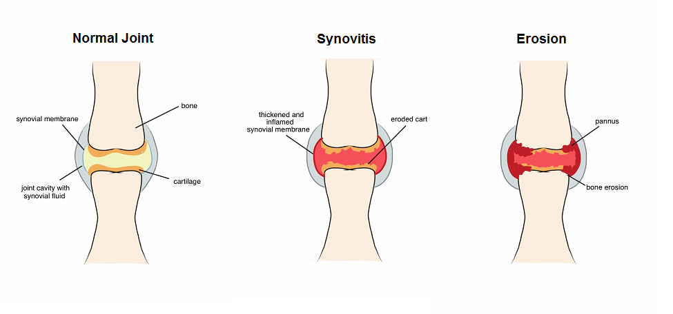 Rheumatoid arthritis in West Hills, CA